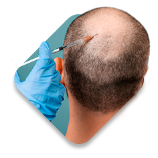 Imagem vista de cima da cabeça de um homem calvo e um médico aplicando uma agulha em seu couro cabeludo