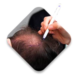 Imagem de médico passando um equipamento na cabeça de um homem calvo