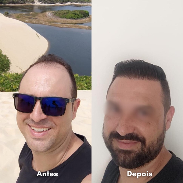 Antes e depois de transplante capilar
