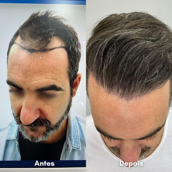 Antes e depois de transplante capilar