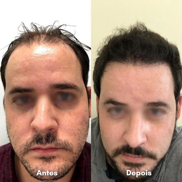 Antes e depois de transplante capilar