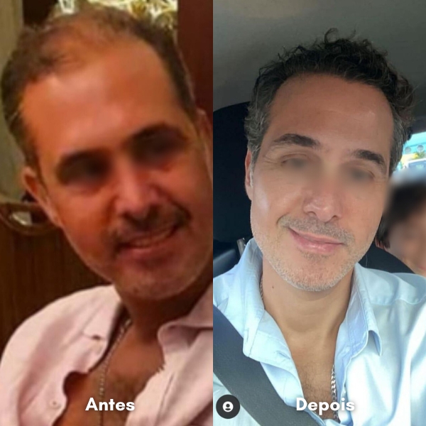 Antes e depois de transplante capilar