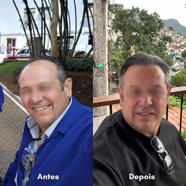 Antes e depois de transplante capilar
