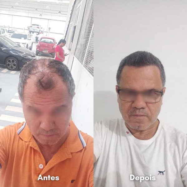 Antes e depois de transplante capilar
